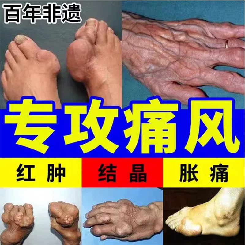 吲哚美辛肠溶胶囊治疗类风湿性关节炎痛风中药缓解炎性疼痛止痛