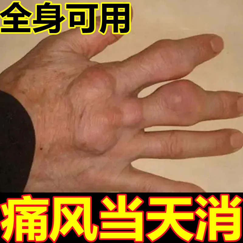 当归拈痛颗丸风湿性关节炎痛风性关节炎(急性期)关节疼痛专用药