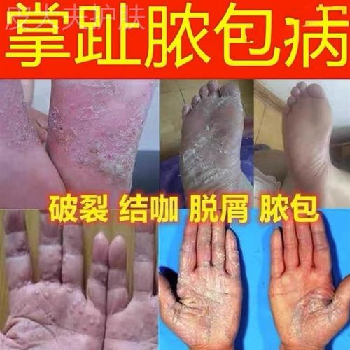新品治掌趾脓疱j病症手脚脓包角化病蜕皮干裂掌跖角皮症专用膏药