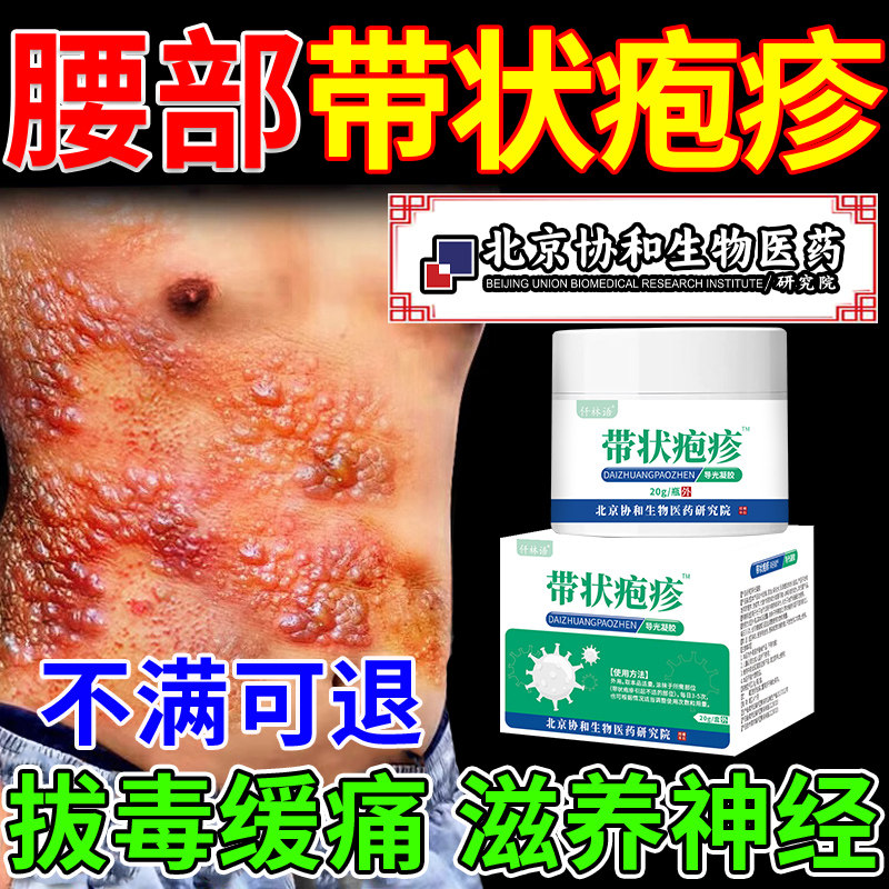 带状疱疹后遗症神经痛蛇盘疮特效膏医用级外用治疗带状疱疹凝胶xo