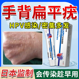 手背扁平疣专用去除膏一抹灵瘊子面颈部丝状疣疣体脱落药房同售ZR
