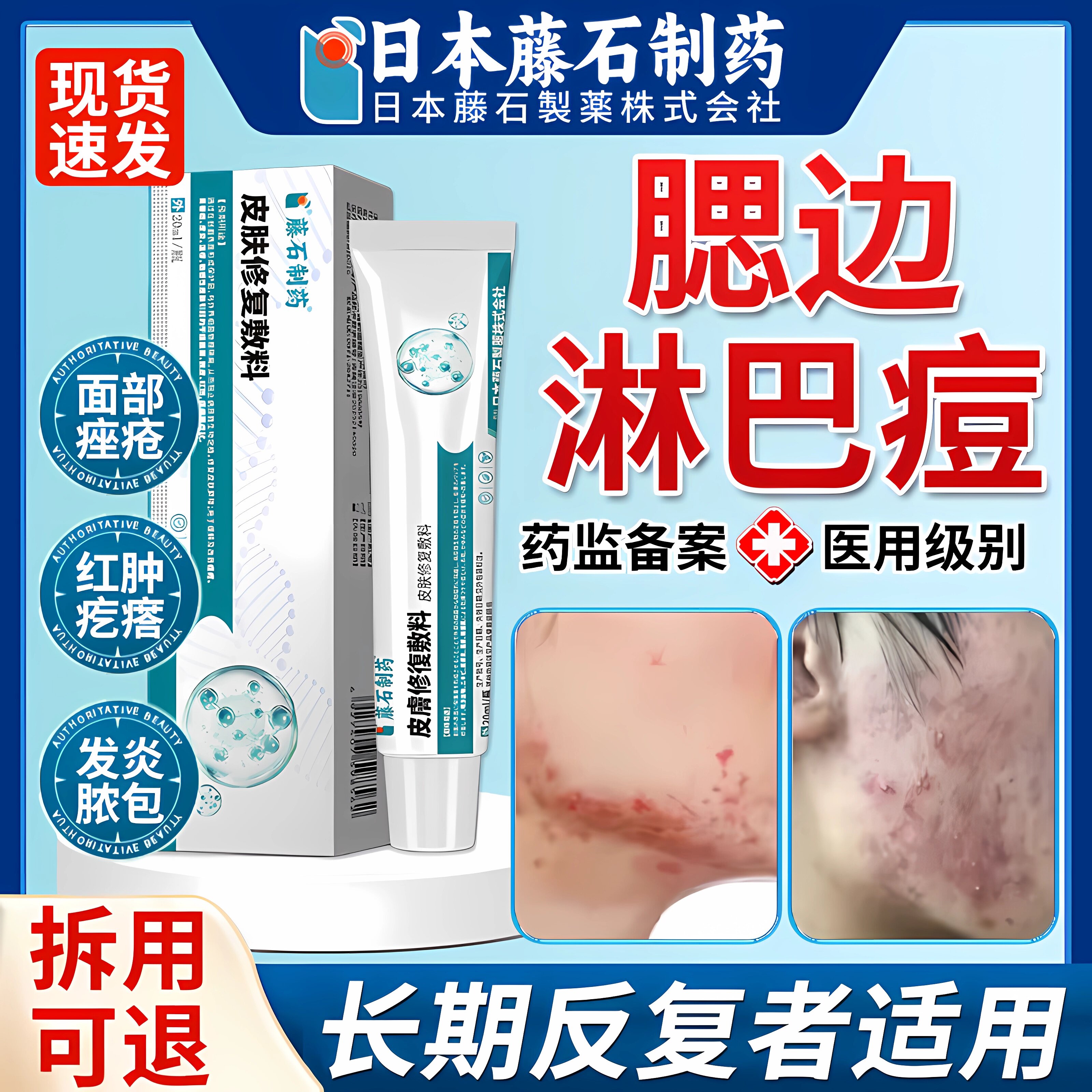 腮边淋巴痘下巴脖子反复长痘硬块痘痤疮脓包毛囊炎粉刺闭合软膏ZR