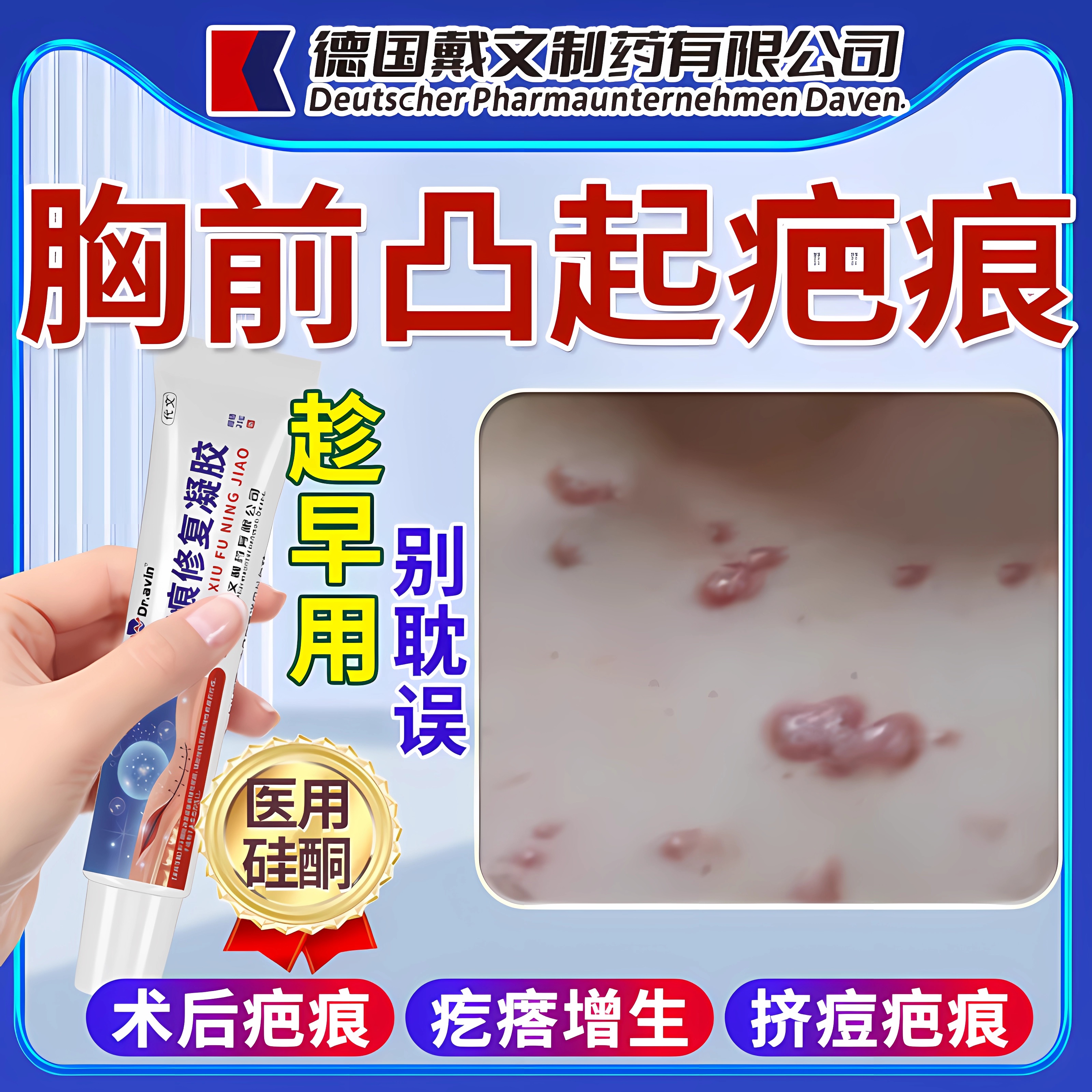 胸口前疤痕增生凸起去除疙瘩止痒凝胶祛手术疤痕痘痘硬肉医用膏ZR