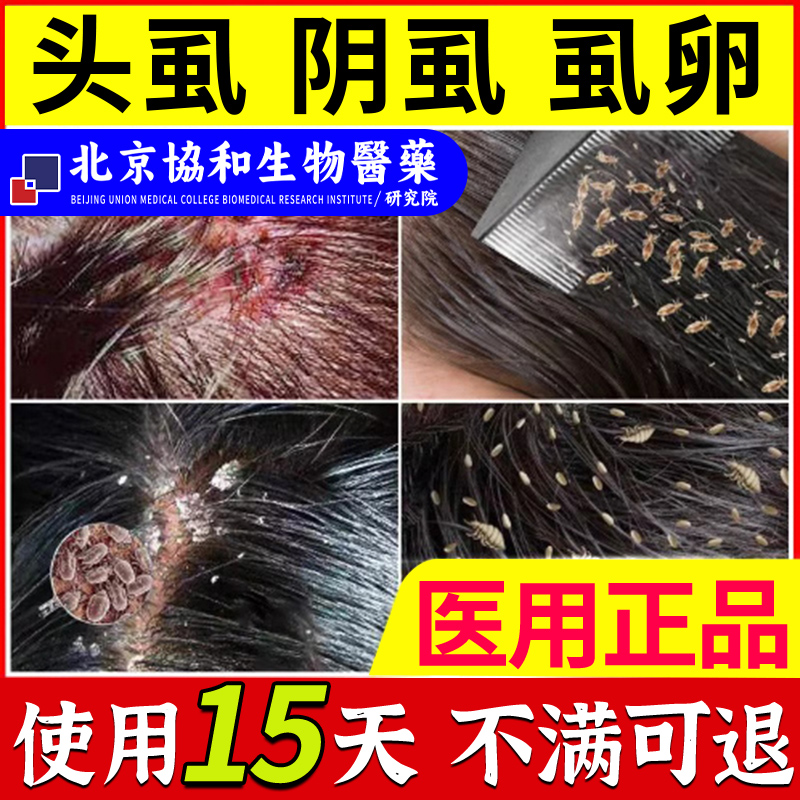 头虱子药儿童头上长虱子瘙痒的药小女孩头发虱立净去除虱卵止痒zp