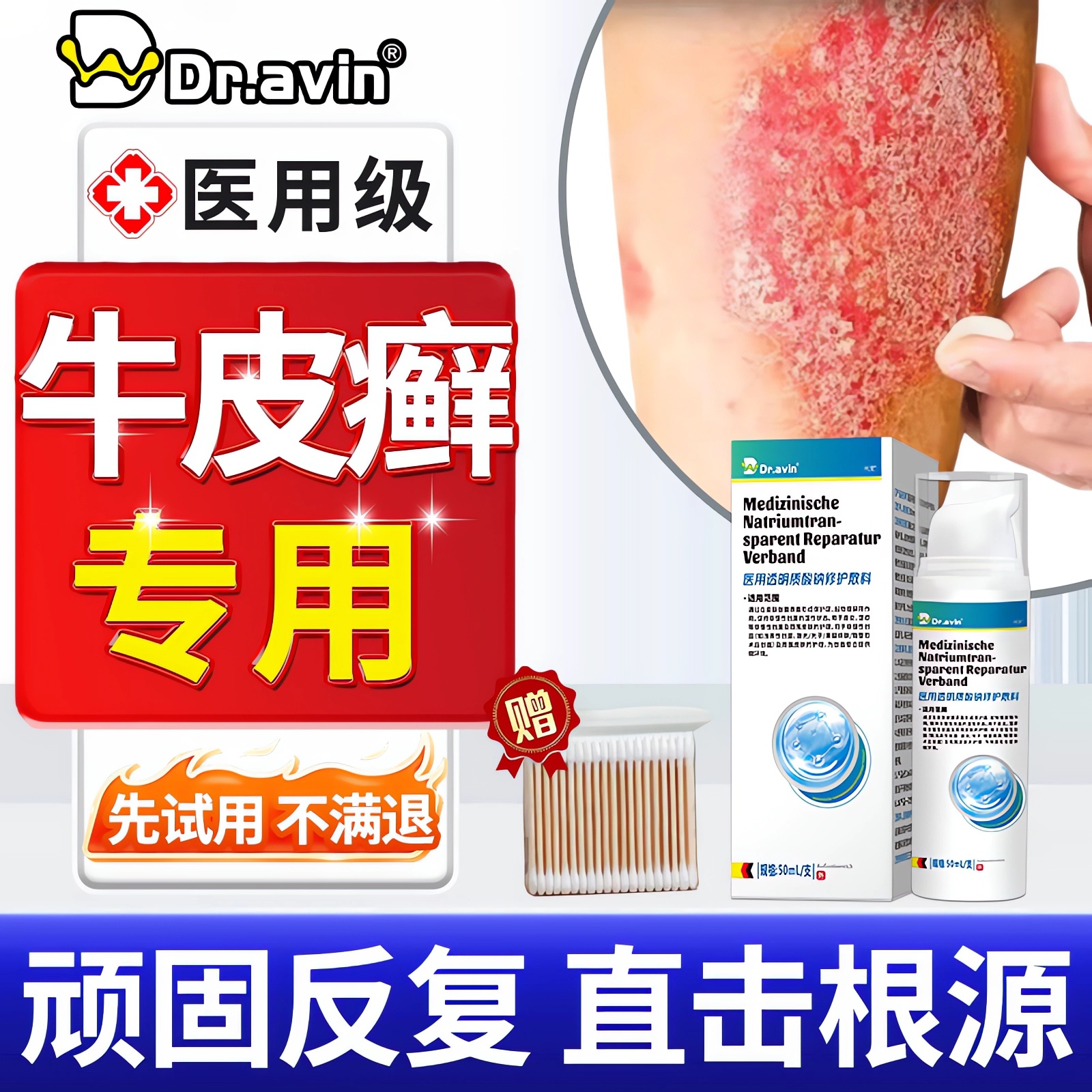 【拆用可退】牛皮癣银屑病专用膏