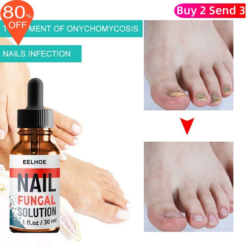 极速Foot Finger Liquid Anti FungaDl Repair Serum Nail Remova