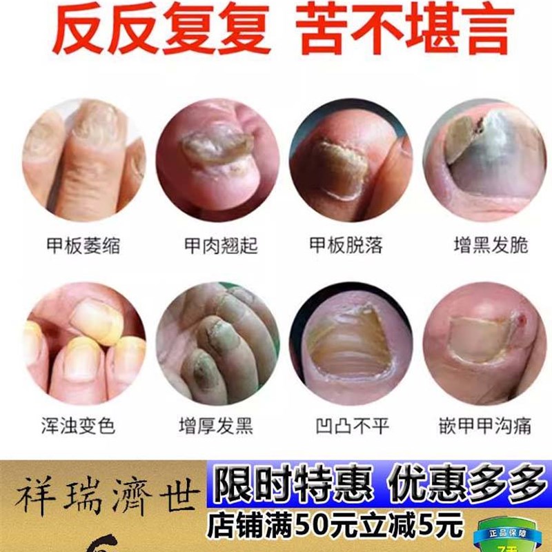 极速黑指甲药灰甲净淤血青手B指甲黑脚趾挤压变黑甲母痣药水