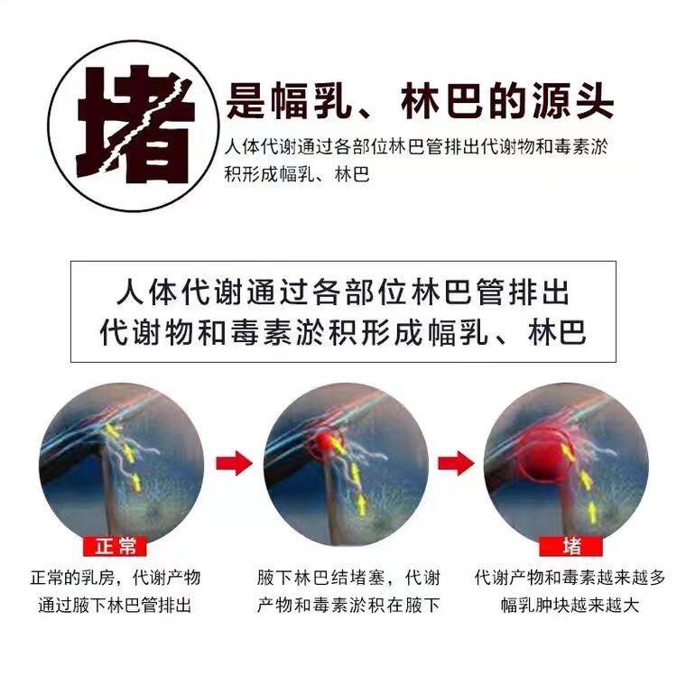 极速淋林巴结肿大散结贴膏副乳消神器耳后腋下淋巴去结节散腋下结