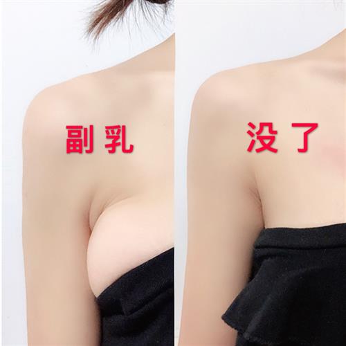副乳没了副乳消除神器去副乳神器副乳贴淋巴疏通淋巴散结膏消贴