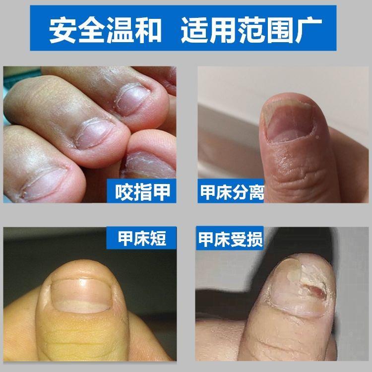 好货指甲修护水甲牀增长液受损再生变厚变硬养甲牀快速修复脚趾甲