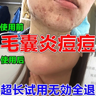 治脸上长痘痘毛囊炎脓包型肉疙瘩磋疮祛痘膏重度暗疮去痘痘中草药