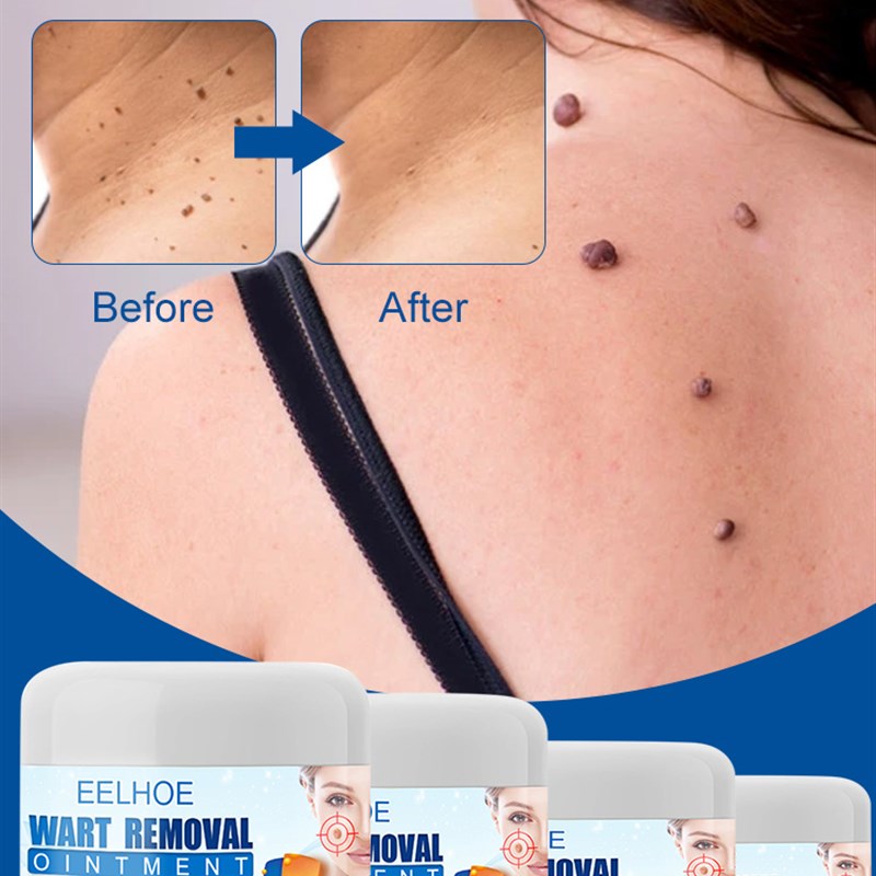 Wart Remover Safe Painless Skin Tags Removal Ointment Fast