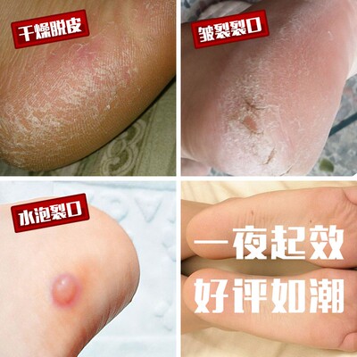速发4只装男足后跟硅胶保护套裂脚后跟干裂痛裂足跟开防裂套防护