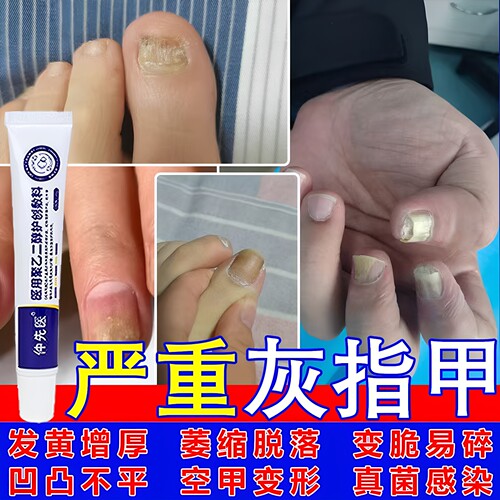 【第二盒低至10元】仲先医灰指甲