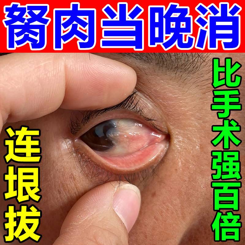 极速眼睛胬肉去除翼状滴眼液息肉疙瘩异物感眼干痒红血丝看不清眼
