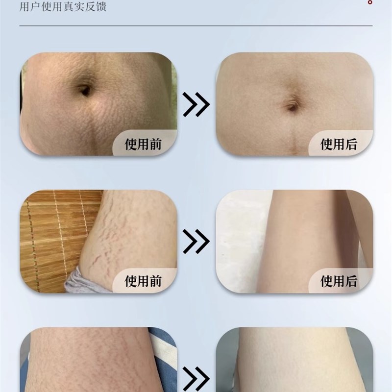 速发肥胖纹修复霜消除生长纹大腿纹妊娠纹身体乳淡化疤痕男女通用