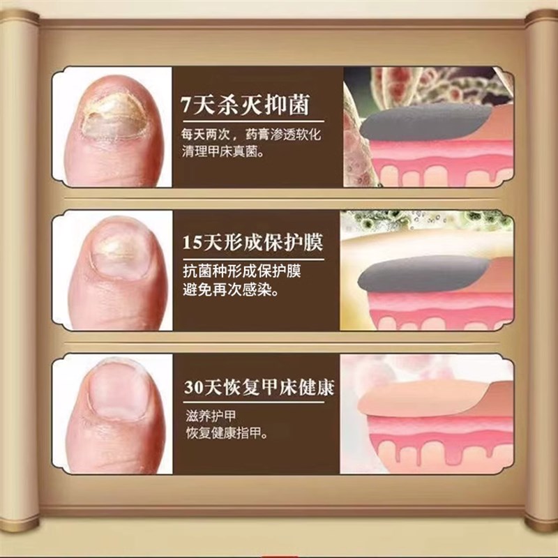 好货脚指甲增厚变黄发黄变厚变硬甲肉分离修复液受损再生黑空软化
