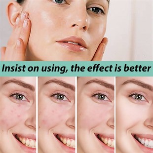 EELHOE Acne Ointment Effective Anti-Acne Treatment Facial Ac