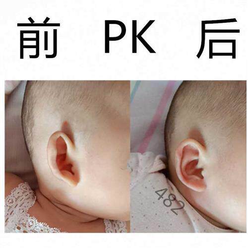 新品宝宝耳朵矫正k器新生儿耳廓纠正器婴儿耳畸形矫形器招风耳垂