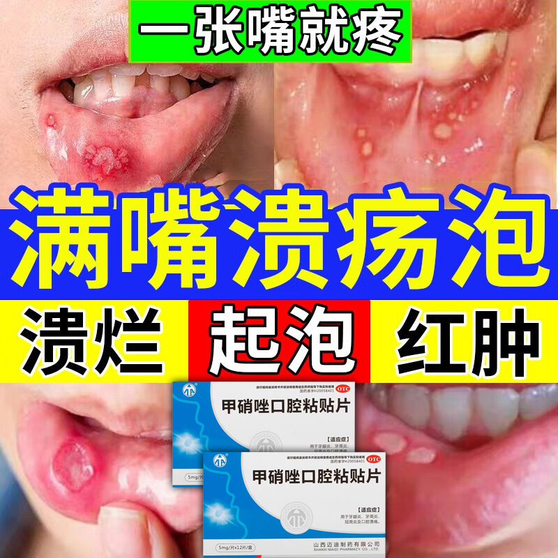 口腔溃疡专用药反复嘴巴烂口疼特烂嘴效清热含片治疗口腔溃疡的药