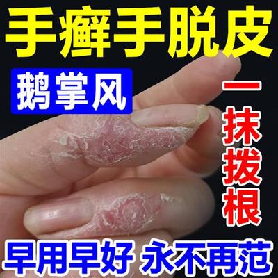 膏感染手足癣脱皮干裂水泡烂脚藓手气药膏