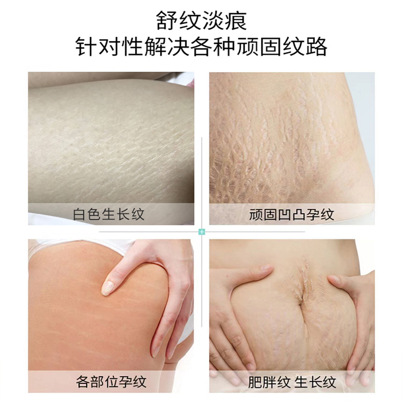 速发肥胖纹去除男福来油去肥胖纹生长纹妊辰纹消除去妊娠纹修复霜