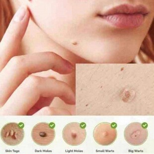 极速Genital Wart Treatmentv Papillomas Removal of Warts Liqu