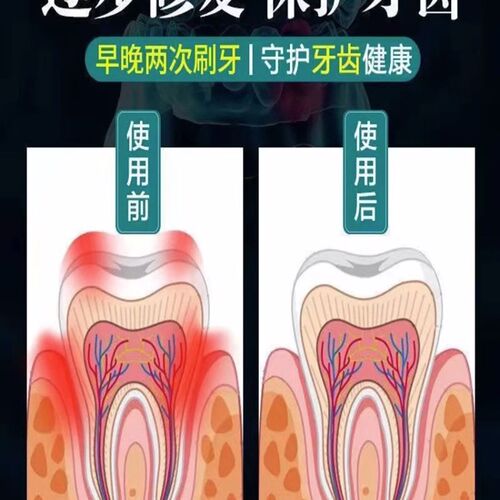 新品【比电焊还牢】牙龈退缩牙根外F露固齿修复牙龈肿痛酸软出血