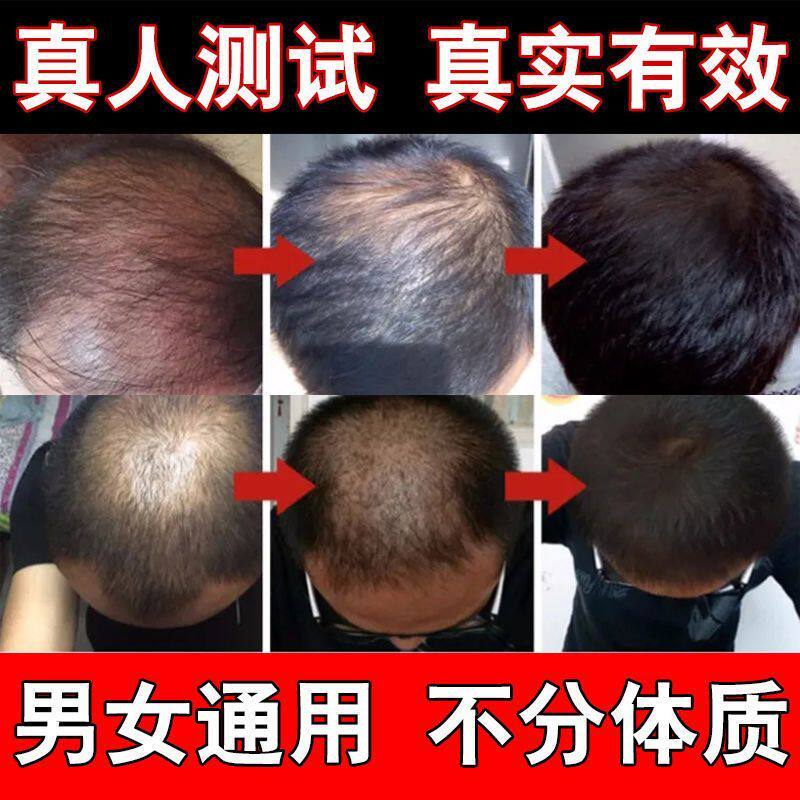 新品后脑勺小块秃掉发鬼剃发毛囊受损修复头发再生斑秃生髪剂秃头