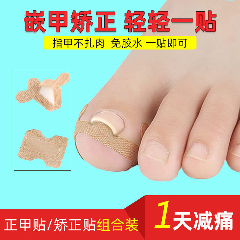 速发甲沟专嵌矫正甲纠正器用甲脚趾甲正甲贴扣矫正贴神器脚沟炎