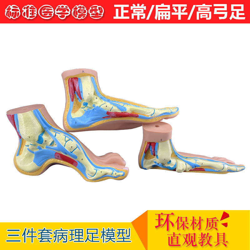 速发正常足 扁平足 弓型足 模型 足部病理模型人体足部肌肉解剖模