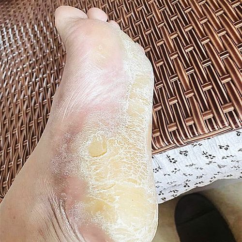 脚后跟粗糙硬皮】手足癣脚底老茧硬化起皮鹅掌风X感染止