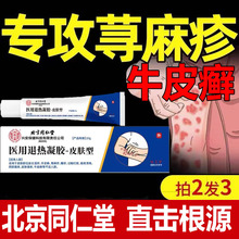 北京同仁堂皮肤瘙痒止痒外用的荨麻疹牛皮癣专用药膏寻荨麻疹过敏止痒断根专用药治疗荨麻疹的特效药荨麻疹药膏银屑病专用药