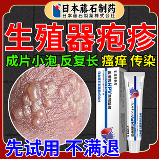 生殖器疱疹膏泡疹断疗根防男女复发外用搭进口真菌感染药监备案OA