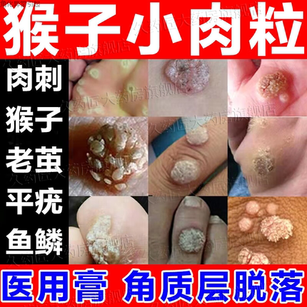 维a酸乳膏胶膏医用去疣瘊子扁平丝状疣专用药脖子上长小肉粒疙瘩