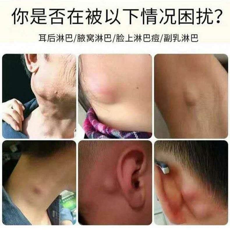 极速【爆卖】淋巴j结散结膏淋巴肿大炎消贴颈部耳后淋巴结硬块热