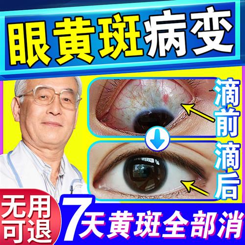 极速眼白发黄清澈去黄混浊眼珠眼球泛黄变白L眼睛黄X斑病变眼水滴