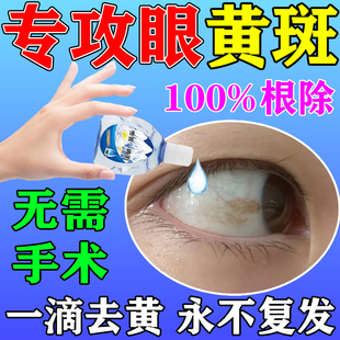 极速眼白清澈去除眼底黄r斑病变眼水去红血丝修复抗疲劳混浊滴眼