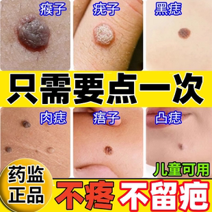 点痣膏无痕正品旗舰店祛痣药水不留疤点痣点斑去痦子专用修护液pk