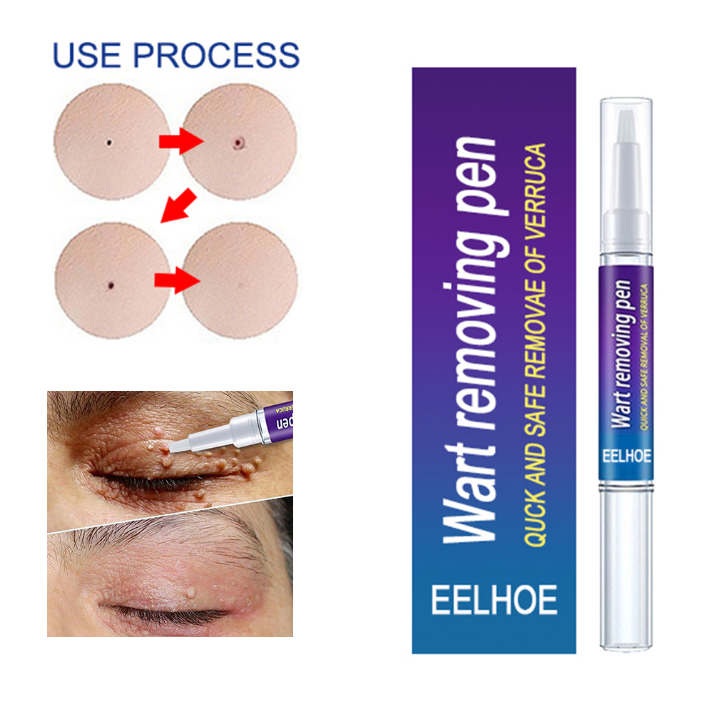 Wart Remover Skin Tag Cream Papillomas Moles Removal