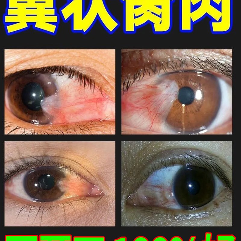 去除眼睛翼状胬肉滴眼液模糊看不清眼角干痒有异物感止痒水