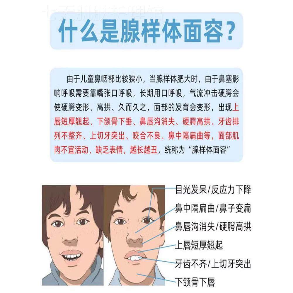 磨牙张嘴呼吸幼儿童调理张嘴呼吸打呼鼻塞腺样体肥大面容矫正器g