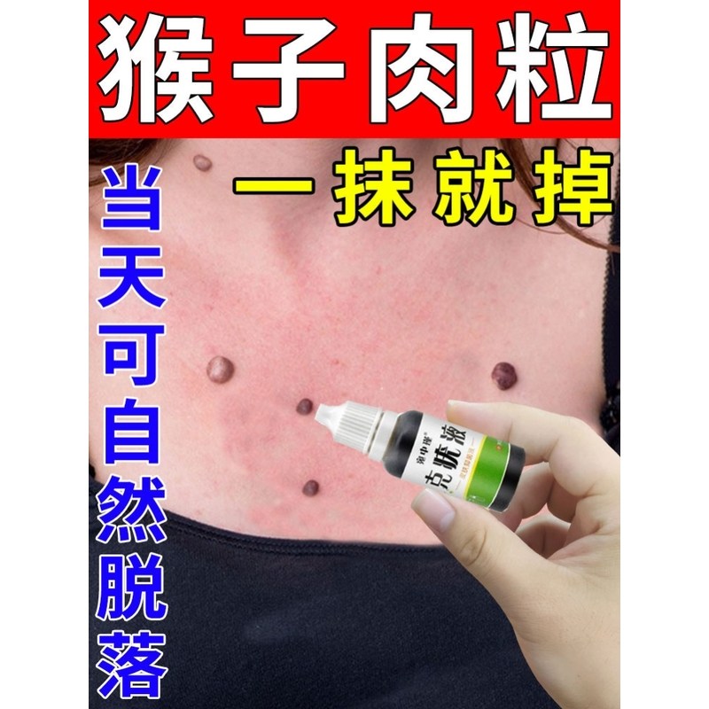 去除尤疣瘊猴子瘊子祛除神器肉粒疙瘩一抹无忧脖子上长小肉粒药膏