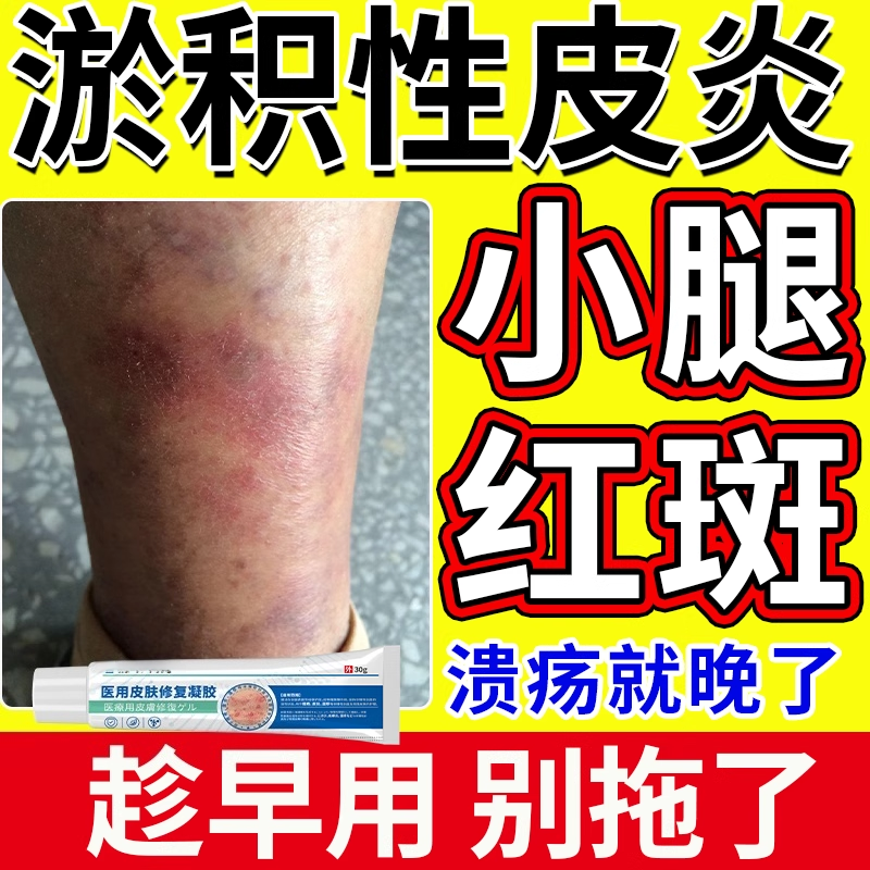 淤积性皮炎专用静脉炎药房同款膏静脉曲张湿疹止痒小腿硬化