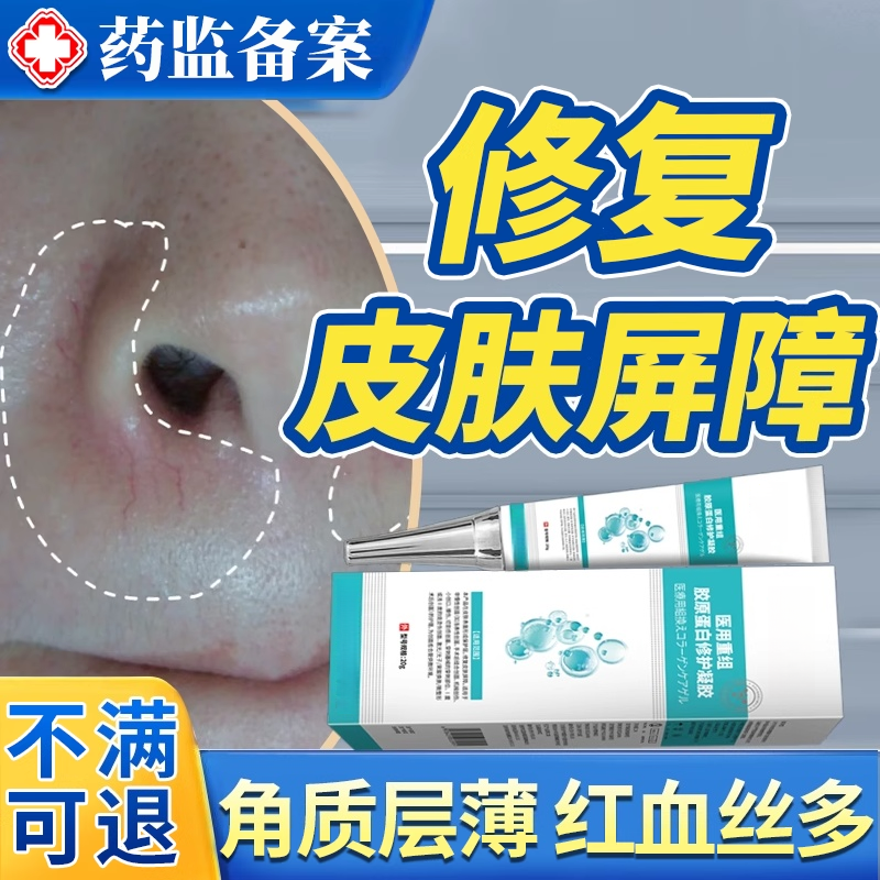 红血丝修去除角质层复祛鼻子两侧发红脱皮鼻翼两边泛红干燥起皮