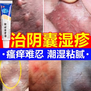 阴囊瘙痒湿疹止痒私处睾丸痒男性阴部裆部潮湿潮热瘙痒脱皮止痒膏