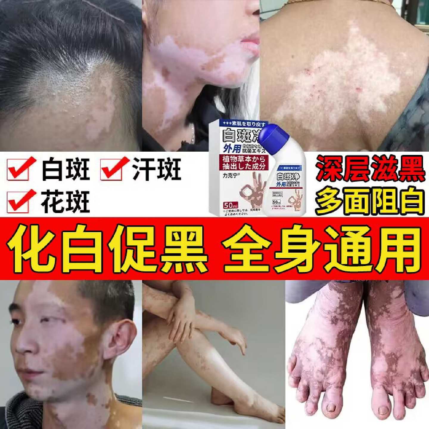白癜膏风外用白斑净促黑色素遮盖液补骨脂酚祛白斑净汗斑花斑旗舰