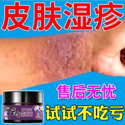 皮肤湿疹止痒去大腿内侧根真菌感染汗疱干燥瘙痒急慢性抑菌紫草膏