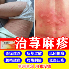 寻荨麻疹治疗特效过敏止痒药断皮肤癣风团性荨麻疹湿疹皮肤瘙痒药