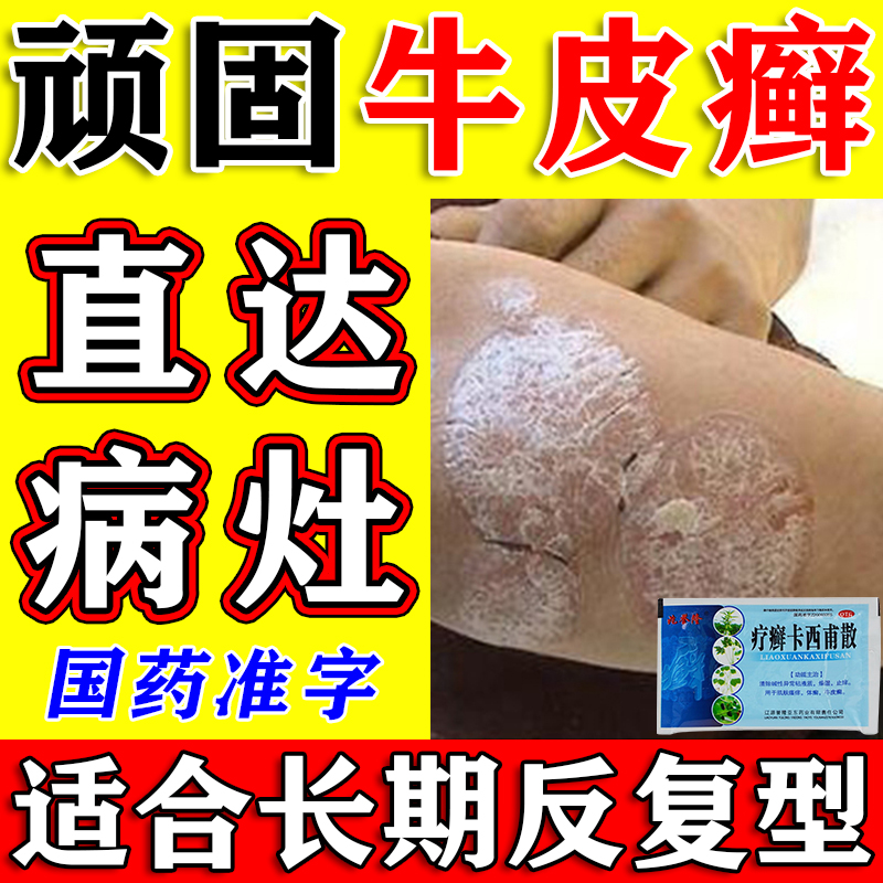 【兆誉隆】疗癣卡西甫散10g*4袋/盒牛皮癣止痒